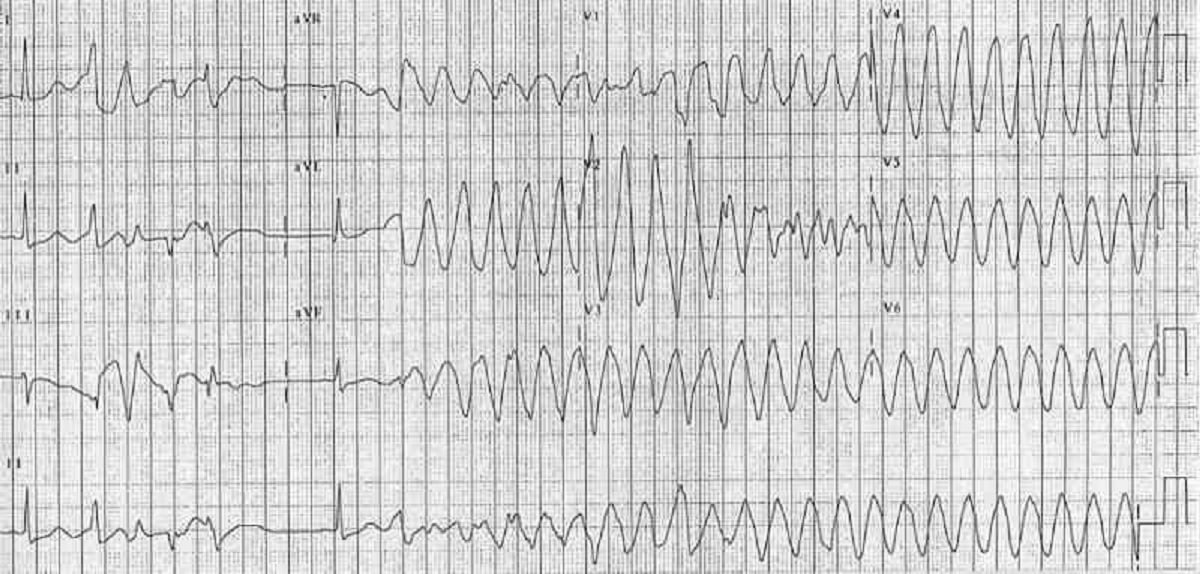 Ekg 13 take the quiz quizmaker