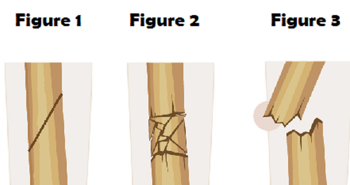 Fractures Quiz ByMohamed Mamdouh Take the Quiz QuizMaker